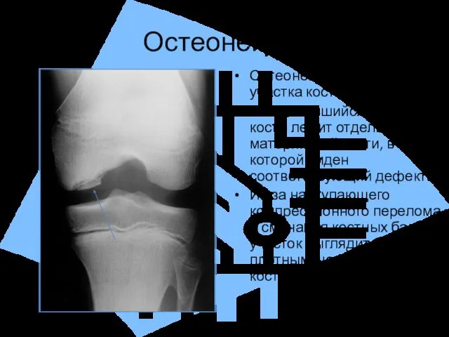 Остеонекроз Остеонекроз – омертвление участка кости. Отторгнувшийся участок кости лежит отдельно