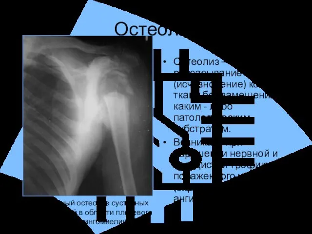 Остеолиз Остеолиз – рассасывание (исчезновение) костной ткани без замещения её каким