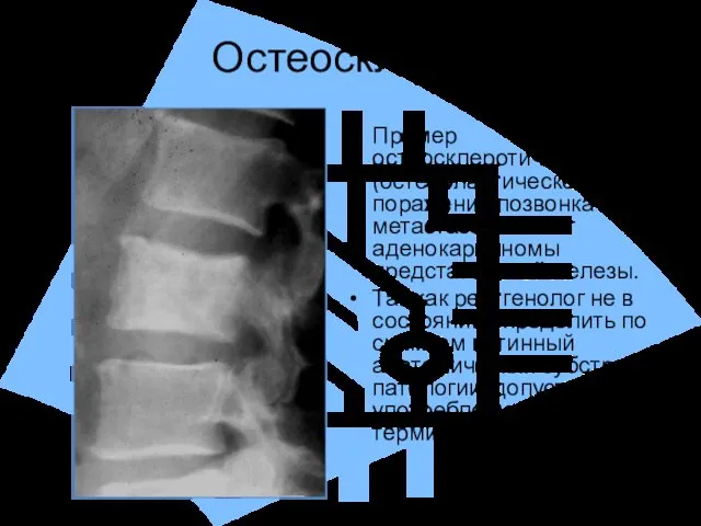 Остеосклероз Пример остеосклеротического (остеобластического) поражения позвонка при метастазе в скелет аденокарциномы