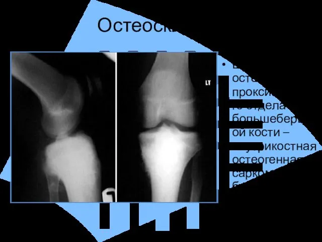 Остеосклероз Выраженный остеосклероз проксимального отдела большеберцевой кости – внутрикостная остеогенная саркома, бластический вариант