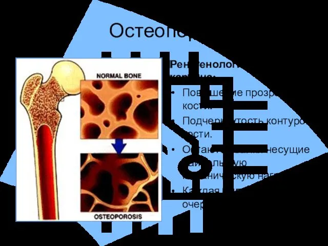 Остеопороз Рентгенологическая картина: Повышение прозрачности кости. Подчеркнутость контуров кости. Остаются балки