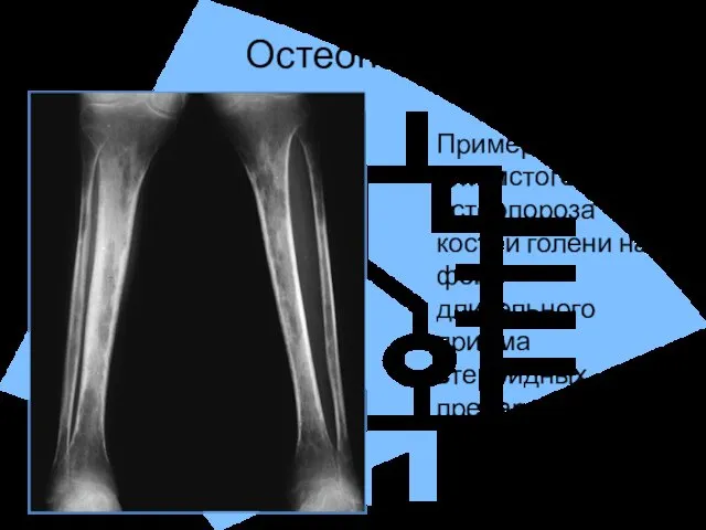 Остеопороз Пример пятнистого остеопороза костей голени на фоне длительного приема стероидных препаратов