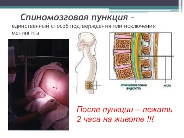 Спиномозговая пункция – единственный способ подтверждения или исключения менингита Ликвор вытекает