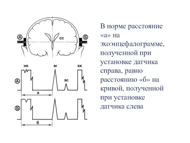 В норме расстояние «а» на эхоэнцефалограмме, полученной при установке датчика справа,