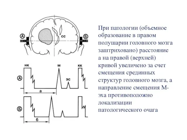 При патологии (объемное образование в правом полушарии головного мозга заштриховано) расстояние