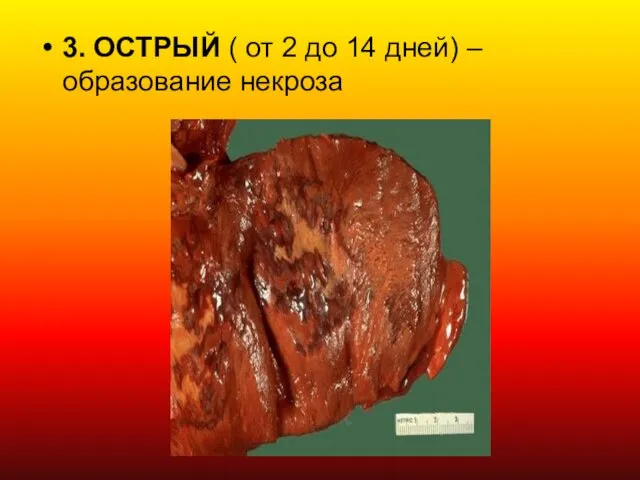 3. ОСТРЫЙ ( от 2 до 14 дней) – образование некроза