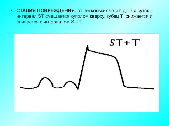 СТАДИЯ ПОВРЕЖДЕНИЯ: от нескольких часов до 3-х суток – интервал ST