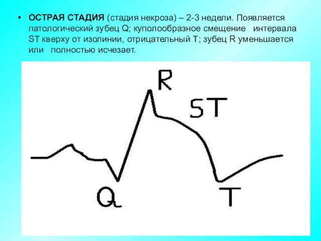 ОСТРАЯ СТАДИЯ (стадия некроза) – 2-3 недели. Появляется патологический зубец Q;