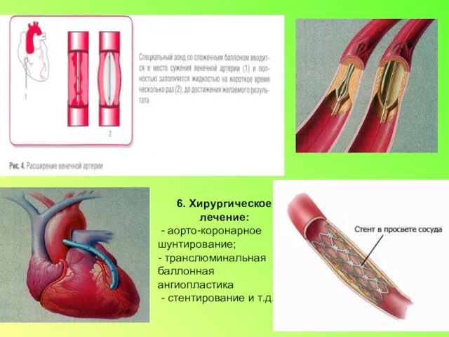 6. Хирургическое лечение: - аорто-коронарное шунтирование; - транслюминальная баллонная ангиопластика - стентирование и т.д.