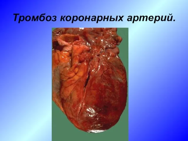 Тромбоз коронарных артерий.