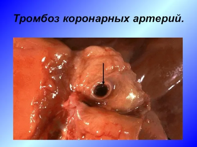 Тромбоз коронарных артерий.