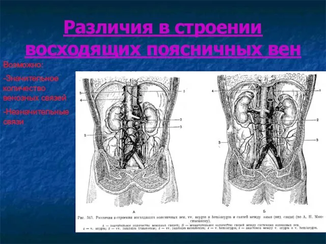 Различия в строении восходящих поясничных вен Возможно: -Значительное количество венозных связей -Незначительные связи