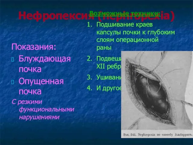 Нефропексия (nephropexia) Показания: Блуждающая почка Опущенная почка С резкими функциональными нарушениями