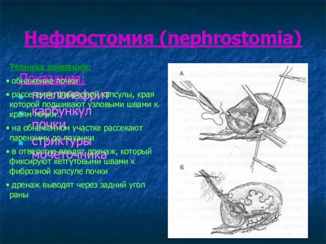 Нефростомия (nephrostomia) Показания: пиелонефрит карбункул почки стриктуры мочеточника Техника операции: обнажение