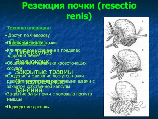 Резекция почки (resectio renis) Показания: Туберкулез Эхинококк Закрытые травмы Огнестрельные ранения