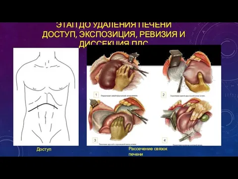 ЭТАП ДО УДАЛЕНИЯ ПЕЧЕНИ ДОСТУП, ЭКСПОЗИЦИЯ, РЕВИЗИЯ И ДИССЕКЦИЯ ПДС Доступ Рассечение связок печени