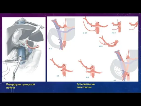 Реперфузия донорской печени Артериальные анастомозы