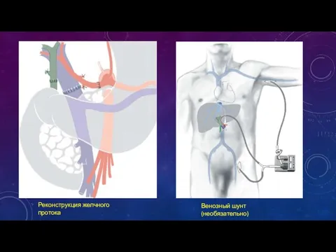 Реконструкция желчного протока Венозный шунт (необязательно)