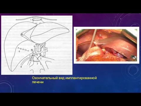 Окончательный вид имплантированной печени