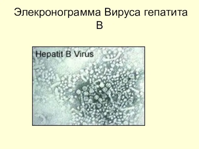 Элекронограмма Вируса гепатита В