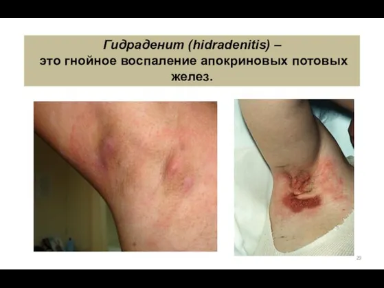 Гидраденит (hidradenitis) – это гнойное воспаление апокриновых потовых желез.