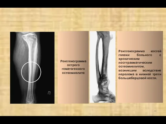 Рентгенограмма острого гематогенного остеомиелита Рентгенограмма костей голени больного с хроническим посттравматическим