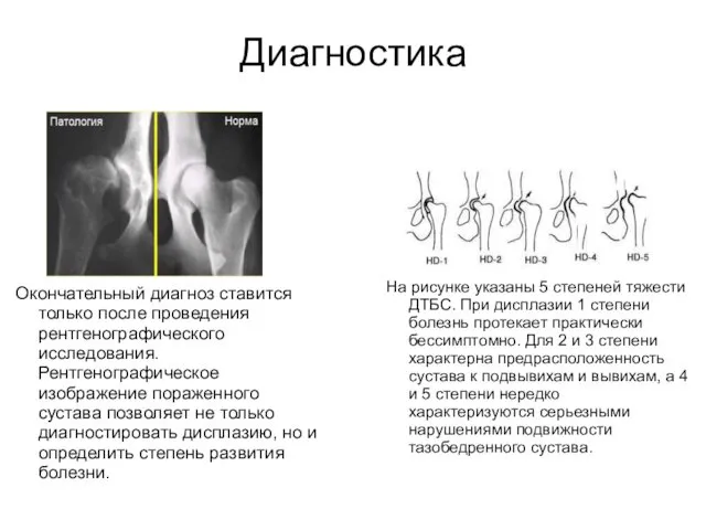 Диагностика На рисунке указаны 5 степеней тяжести ДТБС. При дисплазии 1