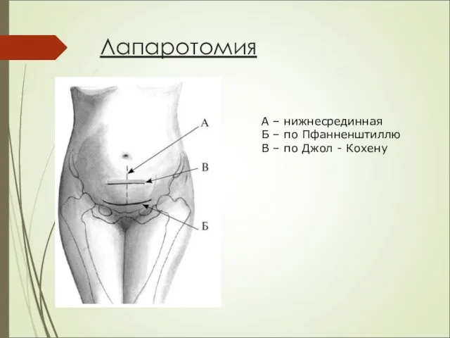 Лапаротомия А – нижнесрединная Б – по Пфанненштиллю В – по Джол - Кохену