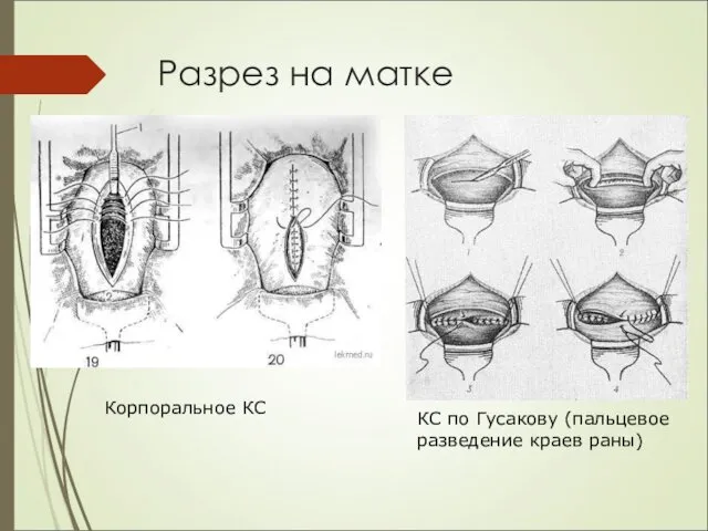 Разрез на матке Корпоральное КС КС по Гусакову (пальцевое разведение краев раны)