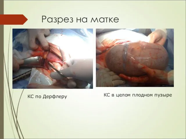 Разрез на матке КС по Дерфлеру КС в целом плодном пузыре