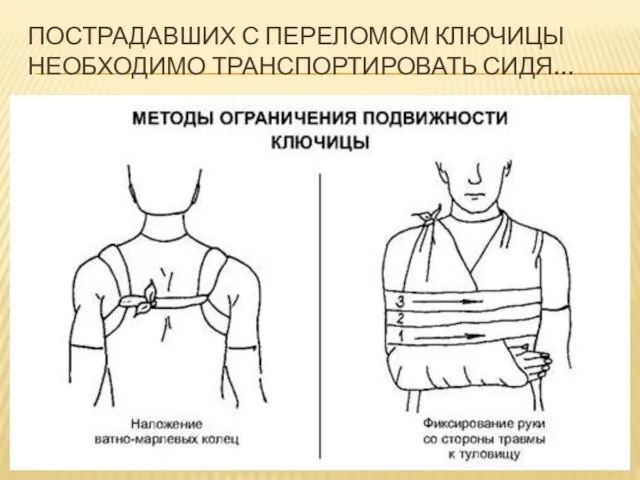 ПОСТРАДАВШИХ С ПЕРЕЛОМОМ КЛЮЧИЦЫ НЕОБХОДИМО ТРАНСПОРТИРОВАТЬ СИДЯ…