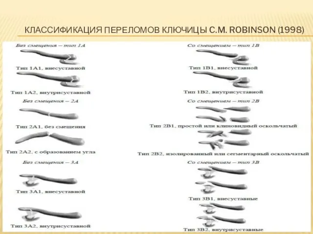 КЛАССИФИКАЦИЯ ПЕРЕЛОМОВ КЛЮЧИЦЫ C.M. ROBINSON (1998)