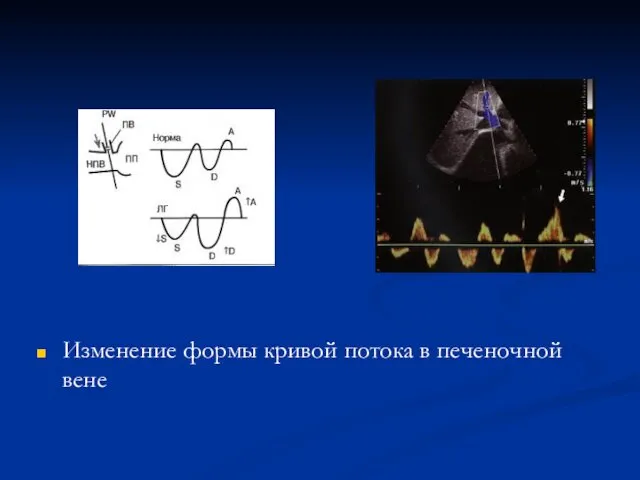 Изменение формы кривой потока в печеночной вене