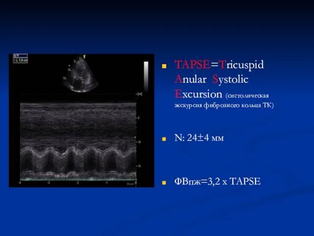 TAPSE=Tricuspid Anular Systolic Excursion (систолическая экскурсия фиброзного кольца ТК) N: 24±4 мм ФВпж=3,2 х TAPSE