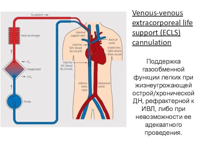 Venous-venous extracorporeal life support (ECLS) cannulation Поддержка газообменной функции легких при
