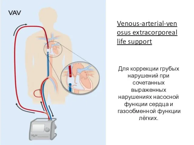 Venous-arterial-venosus extracorporeal life support Для коррекции грубых нарушений при сочетанных выраженных