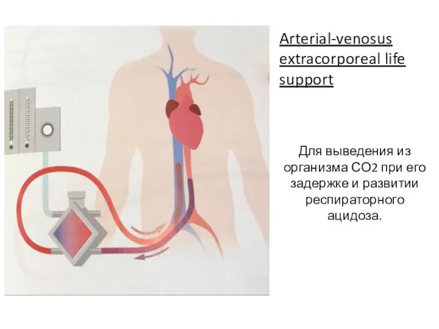 Arterial-venosus extracorporeal life support Для выведения из организма СО2 при его задержке и развитии респираторного ацидоза.