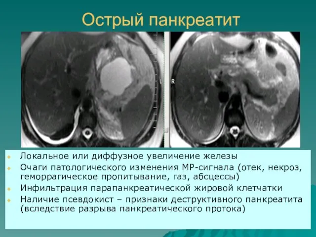 Острый панкреатит Локальное или диффузное увеличение железы Очаги патологического изменения МР-сигнала