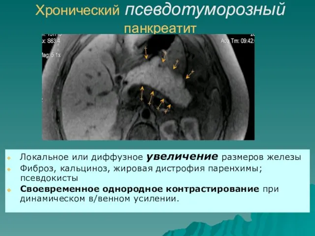 Хронический псевдотуморозный панкреатит Локальное или диффузное увеличение размеров железы Фиброз, кальциноз,