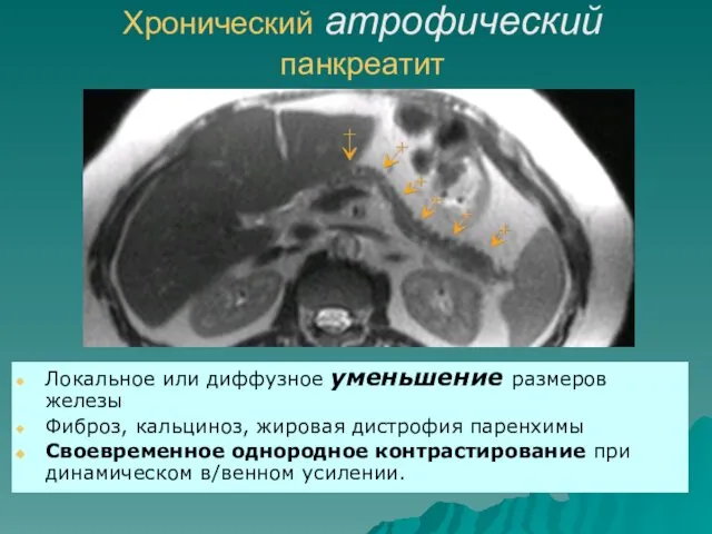 Хронический атрофический панкреатит Локальное или диффузное уменьшение размеров железы Фиброз, кальциноз,