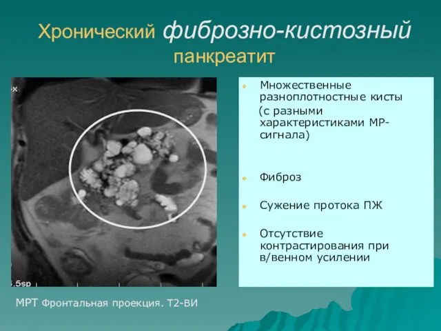 Хронический фиброзно-кистозный панкреатит Множественные разноплотностные кисты (с разными характеристиками МР-сигнала) Фиброз