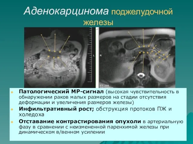 Аденокарцинома поджелудочной железы Патологический МР-сигнал (высокая чувствительность в обнаружении раков малых