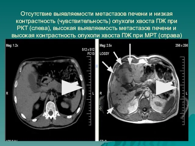 Отсутствие выявляемости метастазов печени и низкая контрастность (чувствительность) опухоли хвоста ПЖ