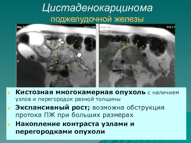 Цистаденокарцинома поджелудочной железы Кистозная многокамерная опухоль с наличием узлов и перегородок