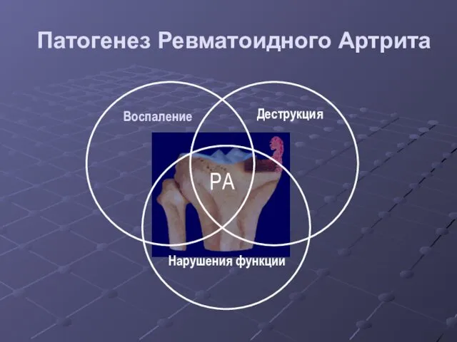 Воспаление Деструкция Нарушения функции РА Патогенез Ревматоидного Артрита