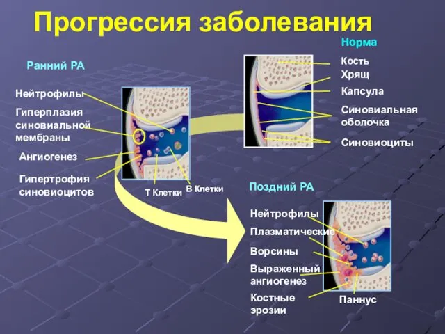 Прогрессия заболевания Ангиогенез Гиперплазия синовиальной мембраны Гипертрофия синовиоцитов Нейтрофилы T Клетки B Клетки Ранний РА