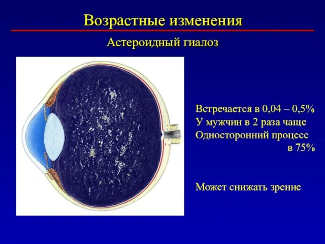 Возрастные изменения Астероидный гиалоз Встречается в 0,04 – 0,5% У мужчин