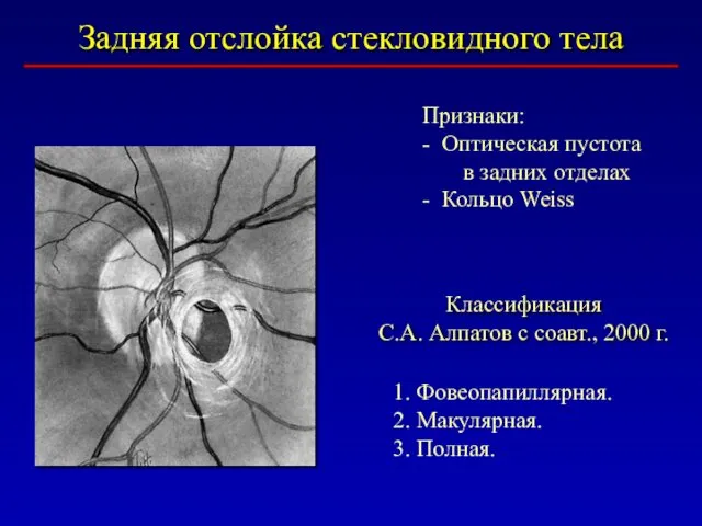 Задняя отслойка стекловидного тела Классификация С.А. Алпатов с соавт., 2000 г.