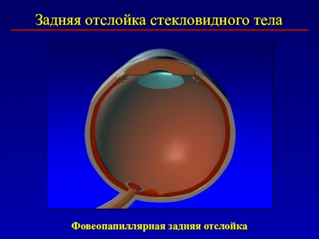 Задняя отслойка стекловидного тела Фовеопапиллярная задняя отслойка