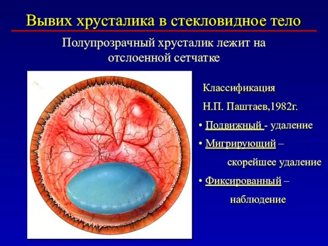 Вывих хрусталика в стекловидное тело Полупрозрачный хрусталик лежит на отслоенной сетчатке